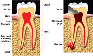 Left: a healthy tooth; Right: an abscessed tooth