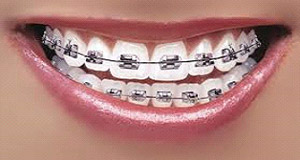 braces