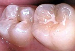 Exemple d'un dent traitée à la résine de scellement et d'une autre, non traitée à la résine de scellement