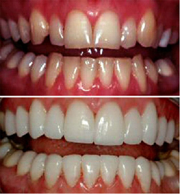 Before and after veneers